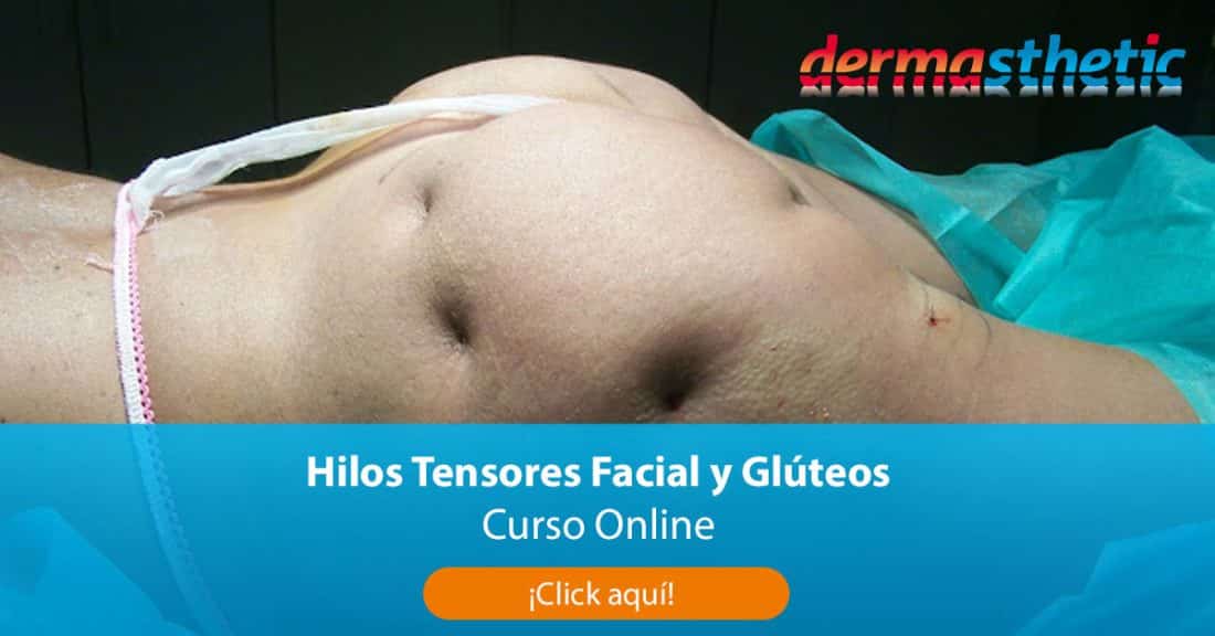 Curso Online de Hilos Tensores Facial y Glúteos » Dermasthetic