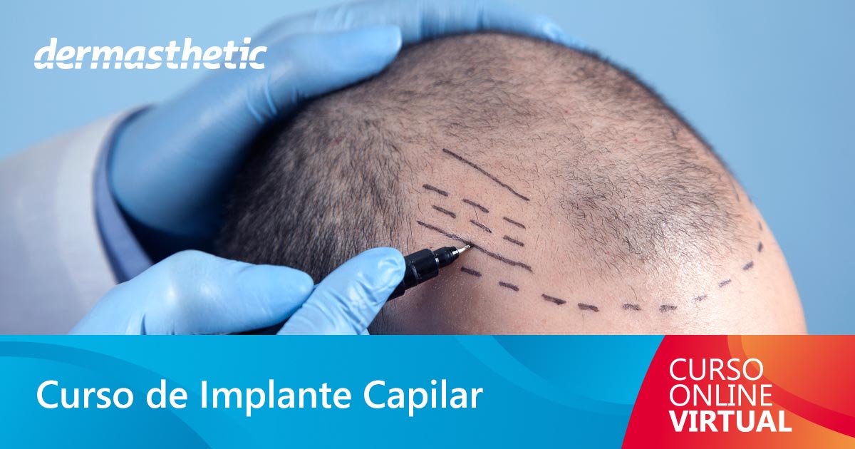 Curso de Implante Capilar